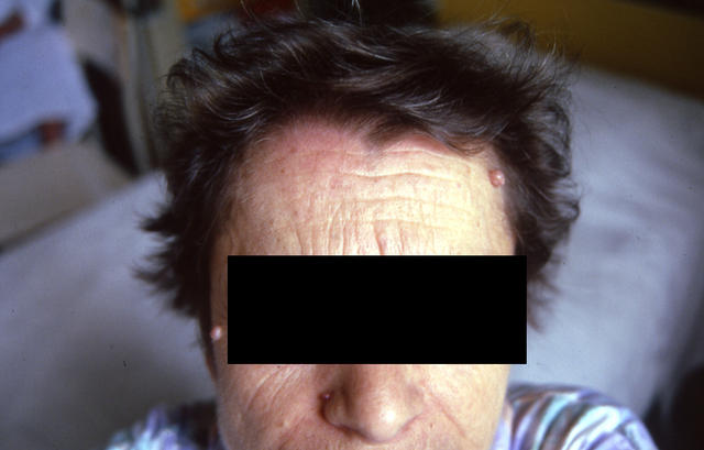 CONNECTIVE TISSUE DISORDERS - Dermatomyositis