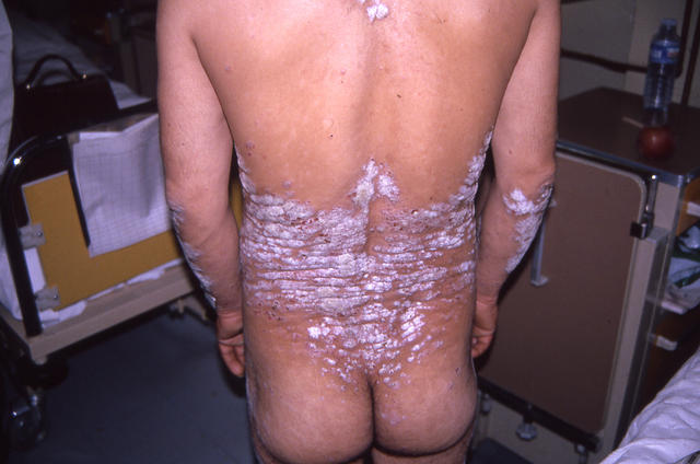 PSORIASIS - Plaque psoriasis