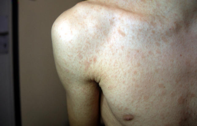 VARIOUS or of UNKNOWN ETIOLOGY DISEASES - Pityriasis rosea