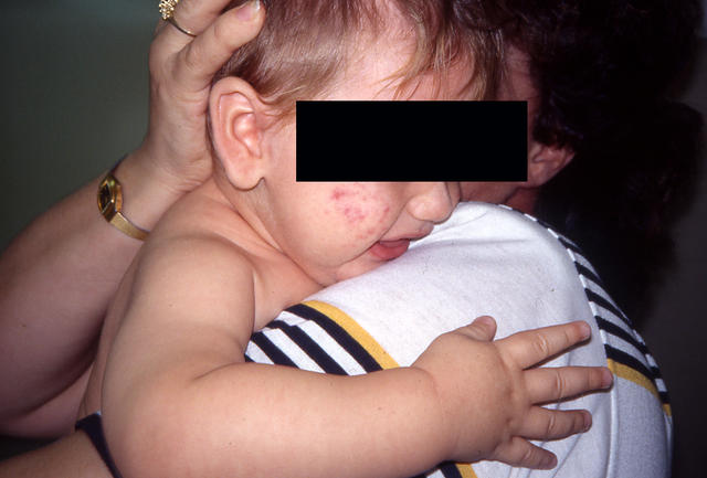 DISEASES OF THE SEBACEOUS GLANDS - Acne infantile