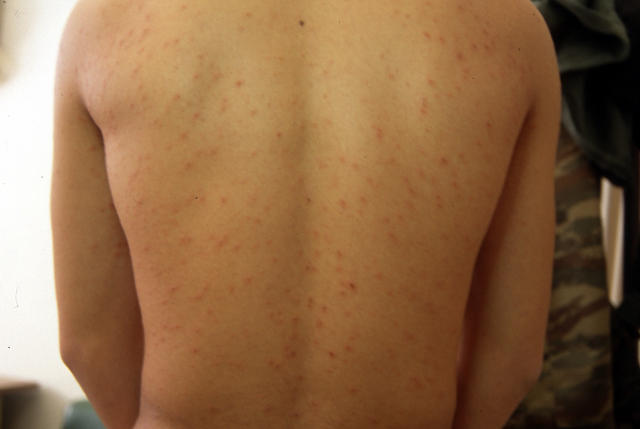 VARIOUS or of UNKNOWN ETIOLOGY DISEASES - Pityriasis rosea