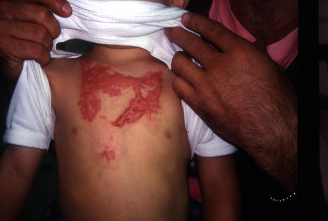 SOFT TISSUE TUMORS - Cheloids SOFT TISSUE TUMORS - Cheloids