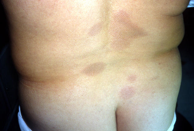 CONNECTIVE TISSUE DISORDERS - Morphea