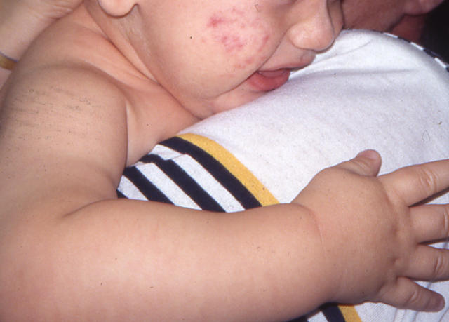 DISEASES OF THE SEBACEOUS GLANDS - Acne infantile