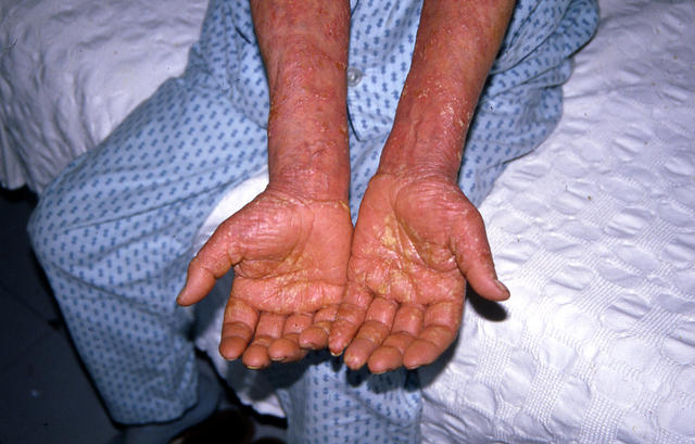 PSORIASIS - Pustular psoriasis