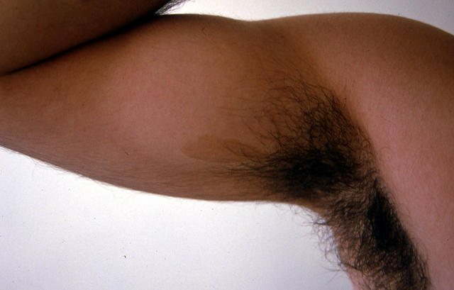PIGMENTATION DISORDERS - Cafe au lait macule PIGMENTATION DISORDERS - Cafe au lait macule