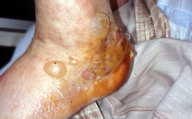 BULLOUS DISEASES - Bullous pemphigoid