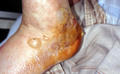 BULLOUS DISEASES - Bullous pemphigoid