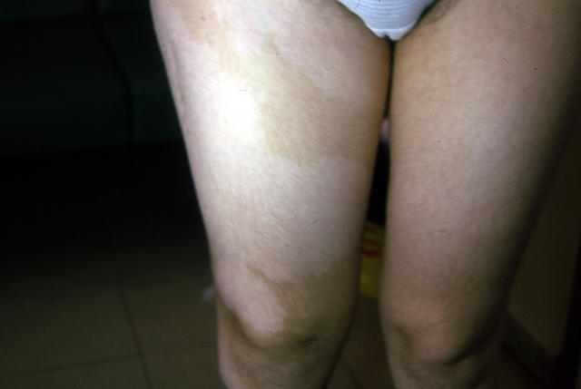 GENODERMATOSES - Tuberous sclerosis complex GENODERMATOSES - Tuberous sclerosis complex