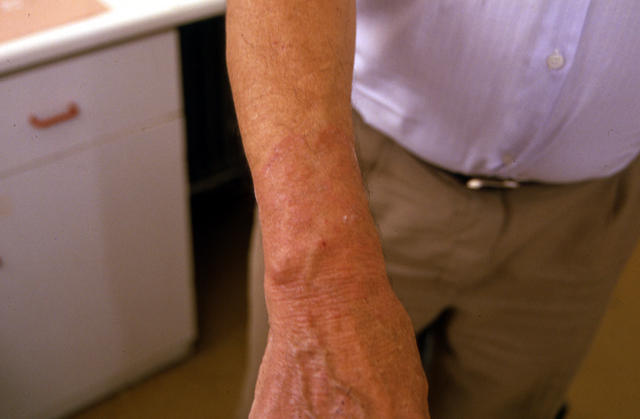 SUPERFICIAL FUNGAL INFECTIONS - Tinea infection SUPERFICIAL FUNGAL INFECTIONS - Tinea infection