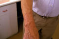 SUPERFICIAL FUNGAL INFECTIONS - Tinea infection