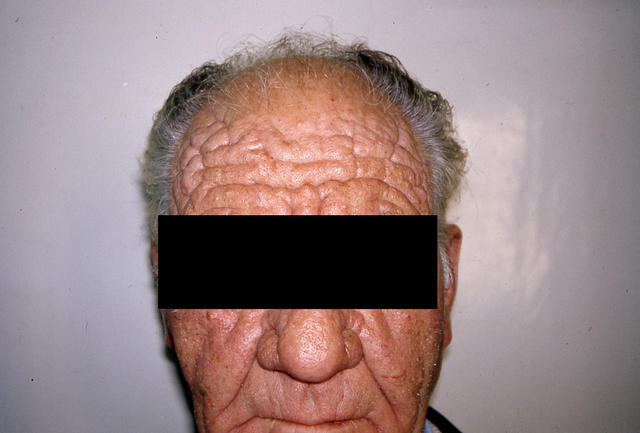 AGEING, PHOTOAGEING - Elastosis AGEING, PHOTOAGEING - Elastosis