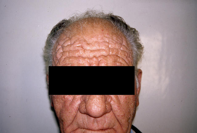 AGEING, PHOTOAGEING - Elastosis