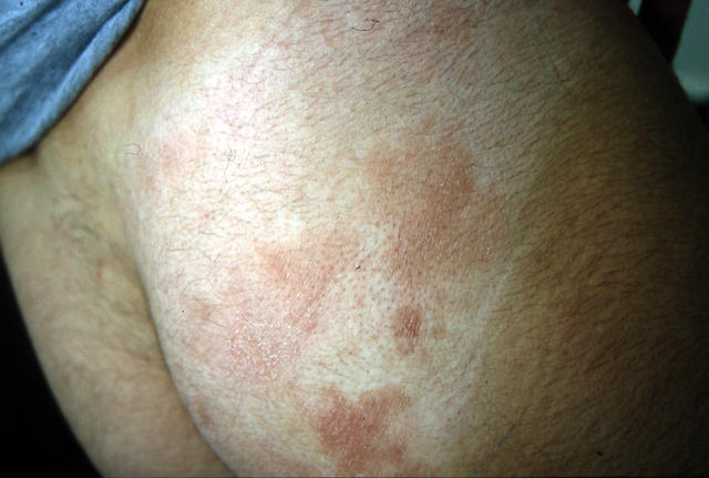 VARIOUS or of UNKNOWN ETIOLOGY DISEASES - Plaque parapsoriasis VARIOUS or of UNKNOWN ETIOLOGY DISEASES - Plaque parapsoriasis