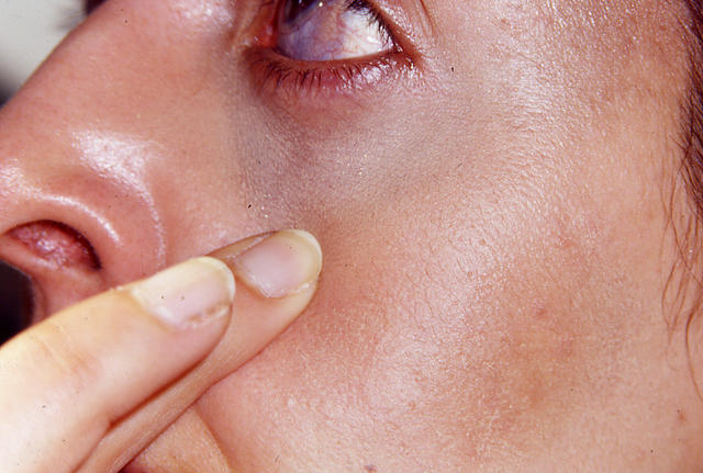 PIGMENTATION DISORDERS - Naevus of Ota PIGMENTATION DISORDERS - Naevus of Ota