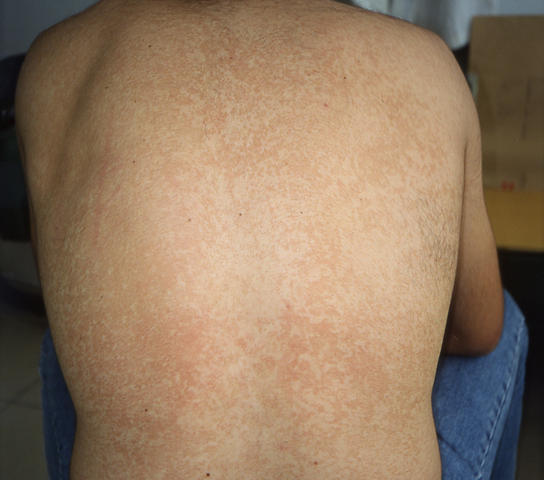 DRUG ERUPTIONS - Drug eruption DRUG ERUPTIONS - Drug eruption