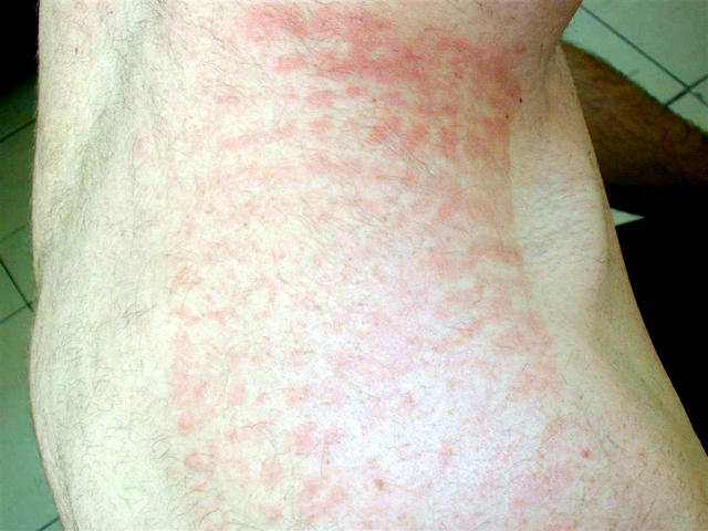 DERMATITIS - EKZEMA - Acute contact dermatitis DERMATITIS - EKZEMA - Acute contact dermatitis