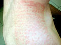 DERMATITIS - EKZEMA - Acute contact dermatitis