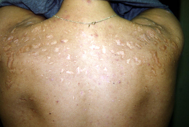 hypertrophic acne scar