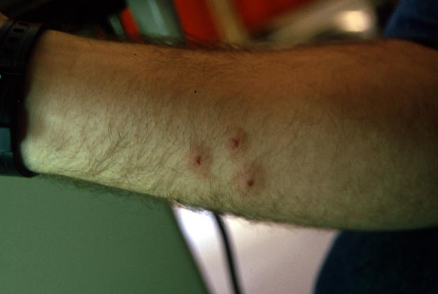 PARASITOSES, BITES - Insect bites