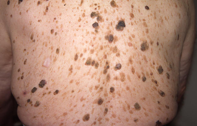 BENIGN SKIN LESIONS, NEVI, CYSTS - Seborrheic keratosis