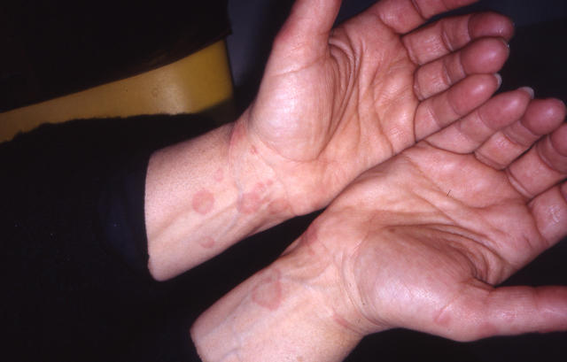 NECROBIOTIC DISORDERS - Granuloma Annulare, multiple NECROBIOTIC DISORDERS - Granuloma Annulare, multiple