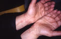 NECROBIOTIC DISORDERS - Granuloma Annulare, multiple