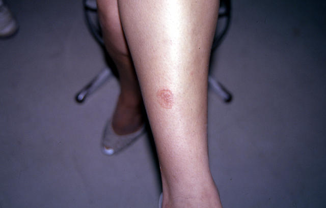 SUPERFICIAL FUNGAL INFECTIONS - Tinea corporis due to trichophyton SUPERFICIAL FUNGAL INFECTIONS - Tinea corporis due to trichophyton