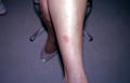 SUPERFICIAL FUNGAL INFECTIONS - Tinea corporis due to trichophyton