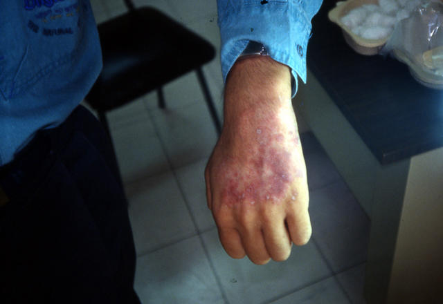 SUPERFICIAL FUNGAL INFECTIONS - Tinea infection