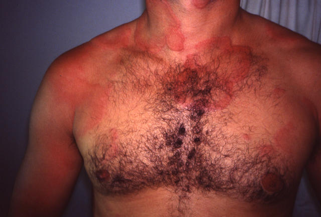 URTICARIA - Urticaria URTICARIA - Urticaria
