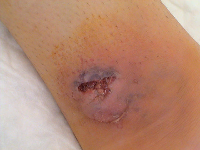 SKIN LESIONS IN SYSTEMIC DISEASES - Pyoderma Gangrenosum in a patient with Ulcerative Colitis