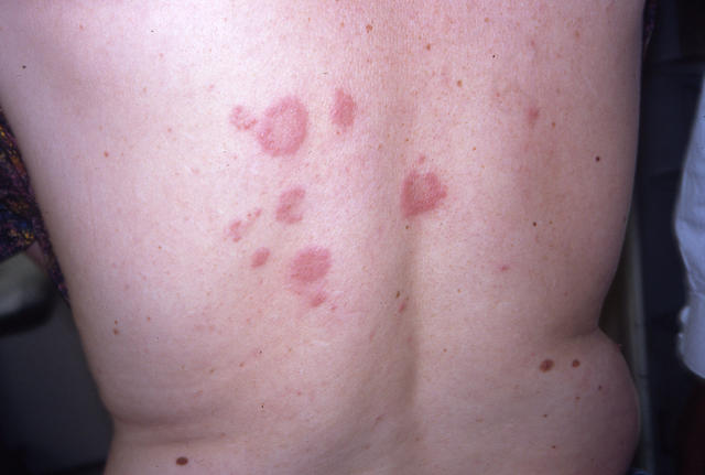 NECROBIOTIC DISORDERS - Granuloma Annulare