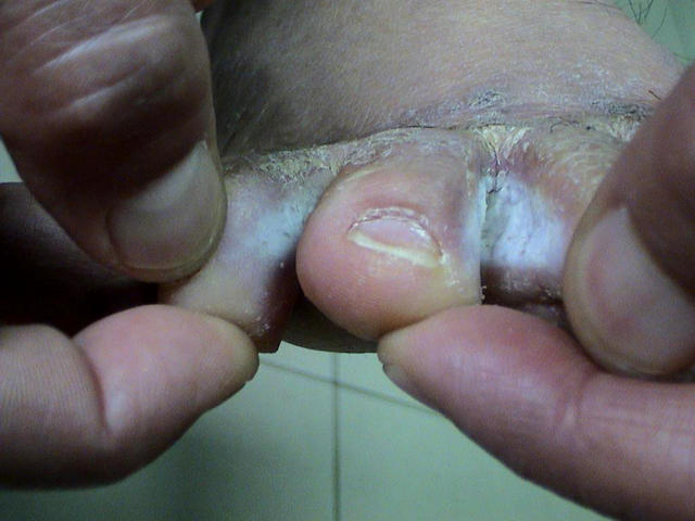 SUPERFICIAL FUNGAL INFECTIONS - Tinea pedis (Athlet's foot)