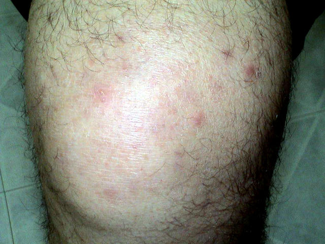 SUPERFICIAL FUNGAL INFECTIONS - Tinea infection