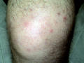 SUPERFICIAL FUNGAL INFECTIONS - Tinea infection