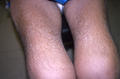 GENODERMATOSES - Ichtyosis vulgaris