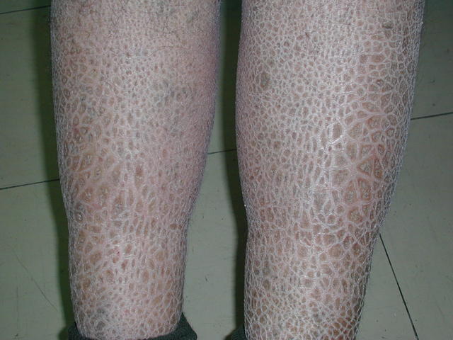 GENODERMATOSES - Ichtyosis vulgaris GENODERMATOSES - Ichtyosis vulgaris