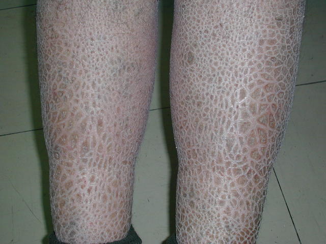 GENODERMATOSES - Ichtyosis vulgaris