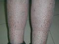 GENODERMATOSES - Ichtyosis vulgaris