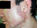 DERMATITIS - EKZEMA - Seborrheic Dermatitis