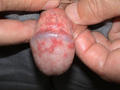 VIRAL INFECTIONS - Genital Herpes