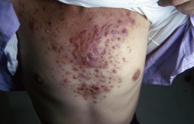 DISEASES OF THE SEBACEOUS GLANDS - Acne, Cystic