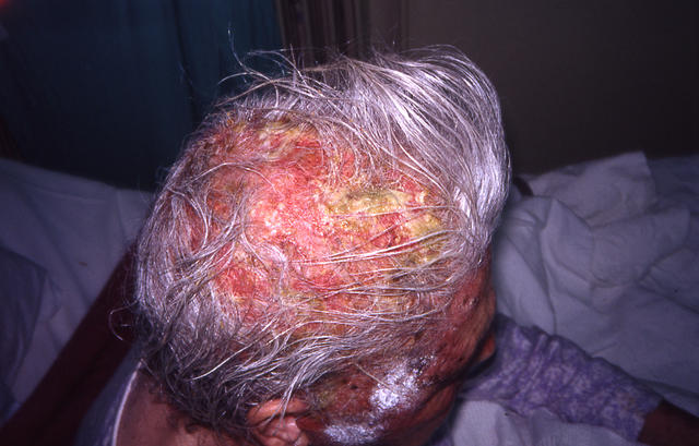 BULLOUS DISEASES - Pemphigus vulgaris