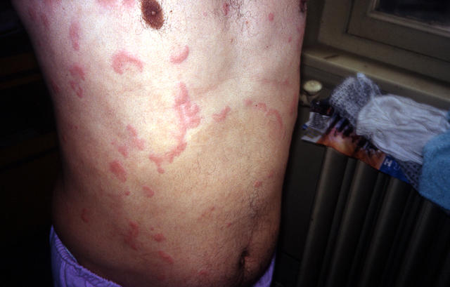 URTICARIA - Urticaria URTICARIA - Urticaria