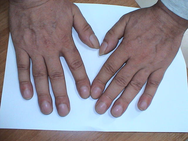 NAIL DISEASES - Clubbing NAIL DISEASES - Clubbing