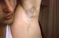 PIGMENTATION DISORDERS - Vitiligo