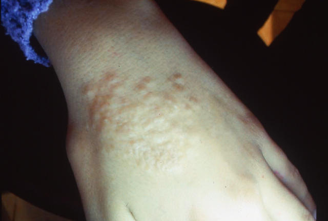 SUPERFICIAL FUNGAL INFECTIONS - Tinea infection