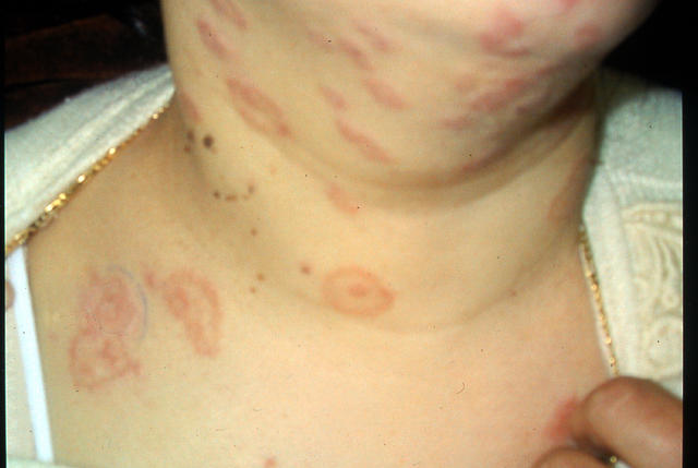 SUPERFICIAL FUNGAL INFECTIONS - Tinea, multiple lesions