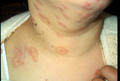 SUPERFICIAL FUNGAL INFECTIONS - Tinea, multiple lesions